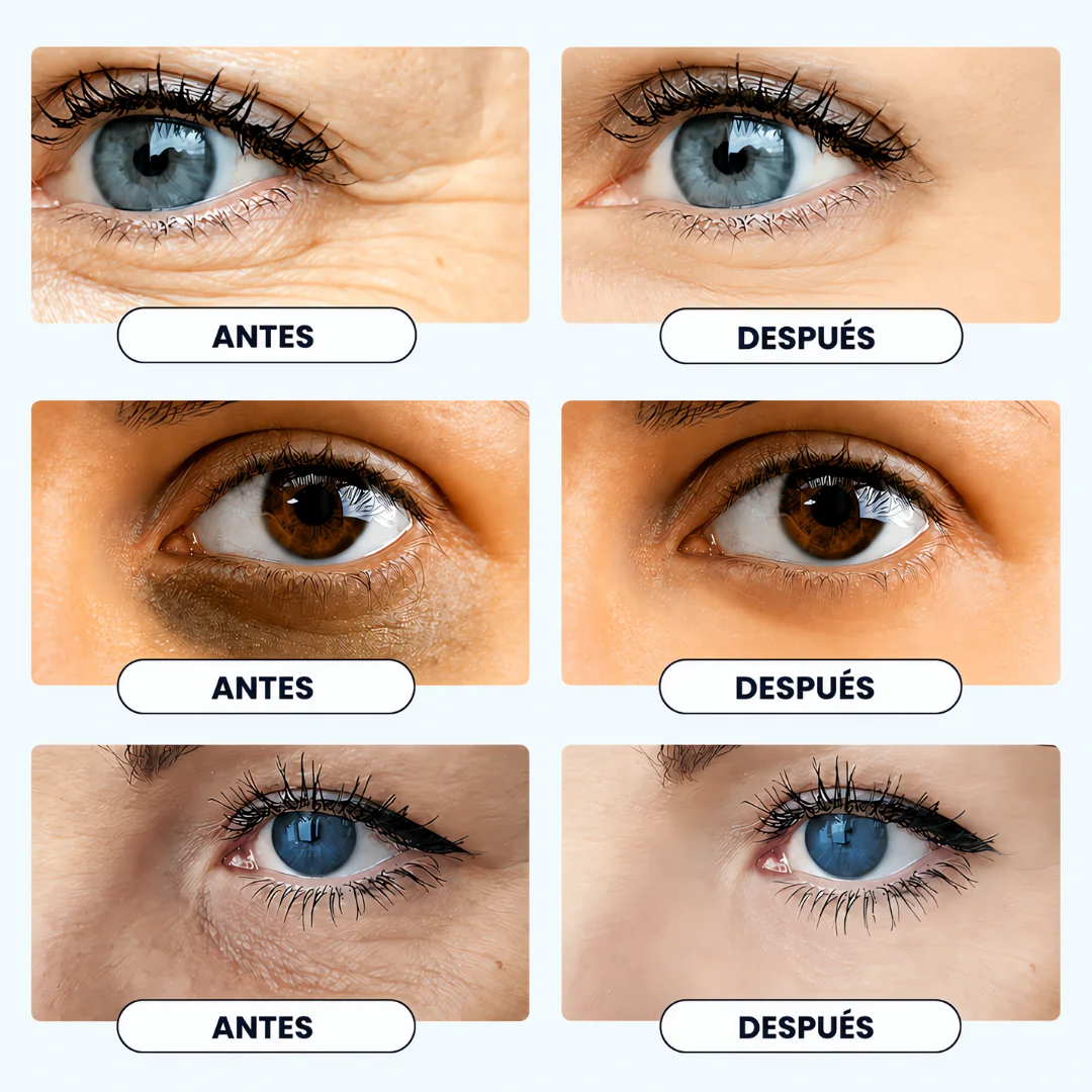 Brilye | Terapia Periocular