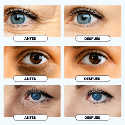 Brilye | Terapia Periocular